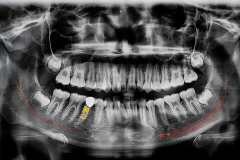 dental implants in calgary