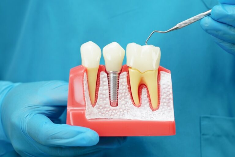 are dental implants safe
