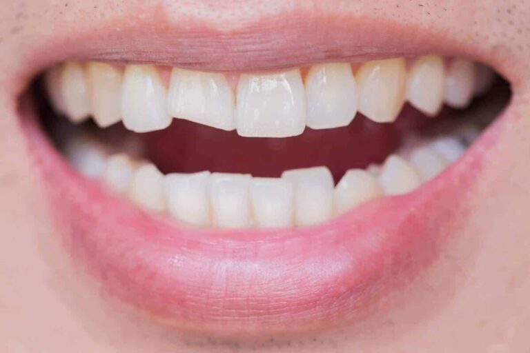 chipped or broken tooth emergency care tips