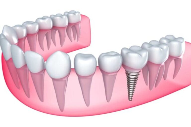 dental implant aftercare tips for long term success